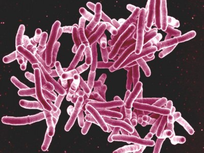 Определить туберкулез стало проще