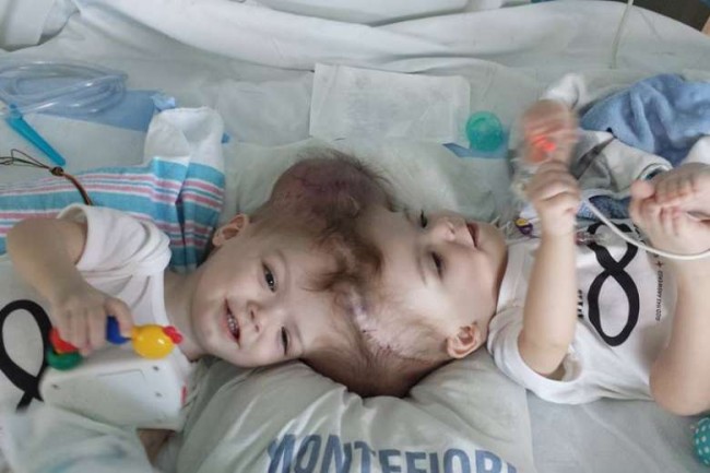 Хирурги США успешно разделили сиамских близнецов