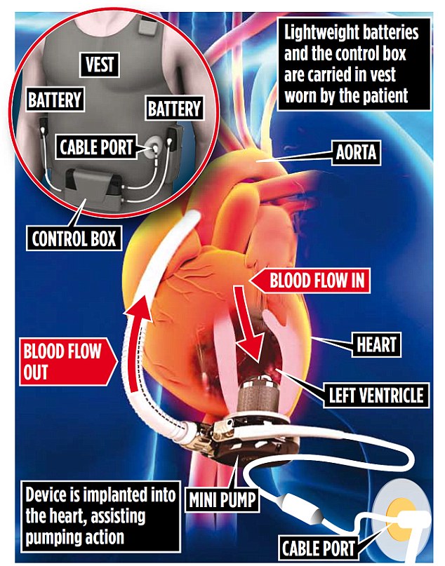 Бионическое сердце послужит лучше имплантата